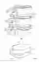 Fig. 02 - INTERVERTEBRAL DISC IMPLANT