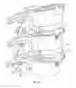 Fig. 14 - INTERVERTEBRAL DISC IMPLANT