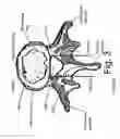 Fig. 04 - Devices and methods for spinal stabilization and instrumentation