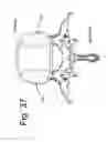 Fig. 41 - Devices and methods for spinal stabilization and instrumentation