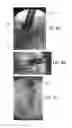 Fig. 07 - Interbody fusion system and methods