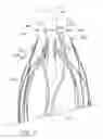 Fig. 07 - Circumferential trigger wire for deploying an endoluminal prosthesis