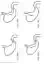 Fig. 36 - Device for intermittently obstructing a gastric opening