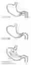 Fig. 37 - Device for intermittently obstructing a gastric opening