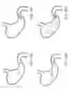 Fig. 38 - Device for intermittently obstructing a gastric opening