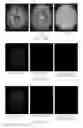 Fig. 13 - Iterative analyzing method for a medical image