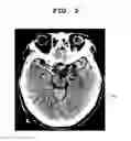 Fig. 06 - Computing system and method for identifying and visualizing cerebral thrombosis based on medical images