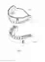 Fig. 02 - REMOVABLE DENTURE