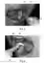 Fig. 06 - TOOTH CLEANING TOOL HAVING A FRONT END FOR ALTERNATIVELY AND RESPECTIVELY REPLACING A PLURALITY OF MULTIFUNCTIONAL AND DISPOSABLE TOOTH CLEANING HEADS