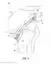 Fig. 02 - Adjustable fixation device