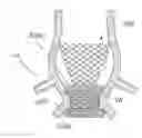 Fig. 01 - Sutureless prosthetic heart valve