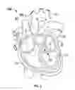 Fig. 02 - Sutureless prosthetic heart valve