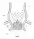 Fig. 09 - Sutureless prosthetic heart valve