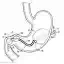 Fig. 01 - Bariatric device and method