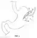Fig. 05 - Bariatric device and method