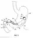 Fig. 06 - Bariatric device and method