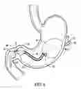 Fig. 07 - Bariatric device and method