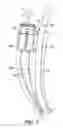 Fig. 08 - Bariatric device and method