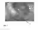 Fig. 08 - Ophthalmic drug sustained release device