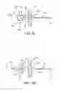 Fig. 15 - Lead fixation accessory, lead stabilization tool, and related procedures