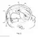 Fig. 29 - Lead fixation accessory, lead stabilization tool, and related procedures