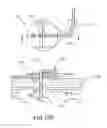 Fig. 37 - Lead fixation accessory, lead stabilization tool, and related procedures
