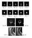 Fig. 02 - Automated segmentation of three dimensional bony structure images