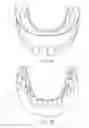 Fig. 05 - Denture-securing device