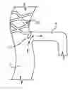 Fig. 01 - Treating eye diseases by deploying a stent