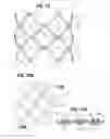 Fig. 09 - Mechanically expandable heart valve