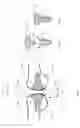 Fig. 02 - System and method for repairing articular surfaces