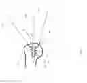 Fig. 12 - System and method for repairing articular surfaces
