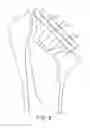 Fig. 09 - Shoulder arthroplasty implant system