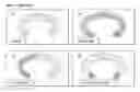 Fig. 01 - Combination therapy intravaginal rings
