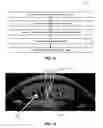 Fig. 06 - Methods and systems for performing a posterior capsulotomy and for laser eye surgery with a penetrated cornea