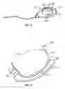Fig. 07 - Intraocular drainage device