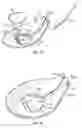 Fig. 09 - Intraocular drainage device