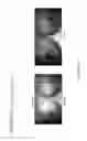 Fig. 16 - Closed loop system for direct harvest and transfer for high volume fat grafting