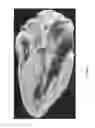 Fig. 02 - Treating congestive heart failure