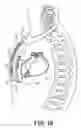 Fig. 03 - Devices and techniques for anchoring an implantable medical device