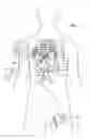 Fig. 02 - Pacing guidewire