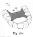 Fig. 09 - Dental appliances with folded material components