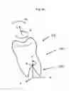 Fig. 05 - Treatment of teeth by aligners