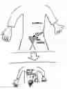 Fig. 01 - Marchand Salpingectomy—A laparoscopic surgical technique