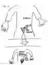 Fig. 02 - Marchand Salpingectomy—A laparoscopic surgical technique