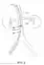 Fig. 07 - DEVICES AND METHODS FOR TREATING ACUTE KIDNEY INJURY