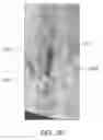 Fig. 35 - DEVICES AND METHODS FOR TREATING ACUTE KIDNEY INJURY