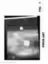 Fig. 02 - Internal fixation device for the pediatric correction of severe bone malformations