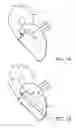 Fig. 02 - Image guidance of a steerable introducer for minimally invasive procedures