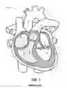 Fig. 02 - Heart valve repair and replacement